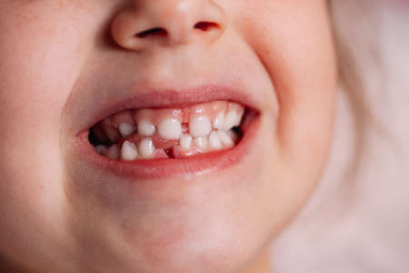 close-up clenched teeth of a five-year-old child showing a recent gum wound from a fallen baby tooth