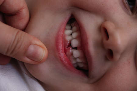 mother hand pulling the daughter lower lip down and showing hole in the gum from the fallen...
