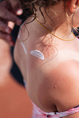 father apply sun protection cream on his daughters burnt back on a hot summer sunny dayの写真素材
