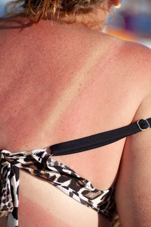 close-up red tan back with white lines from a leopard swimsuit