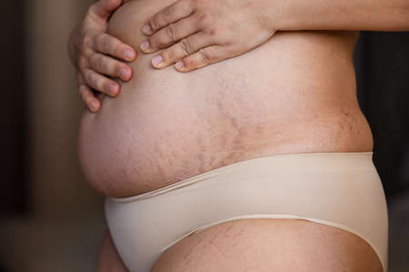 Cropped image fat overweight woman hand on tummy, with stretch marks, striae. Childbirth body....