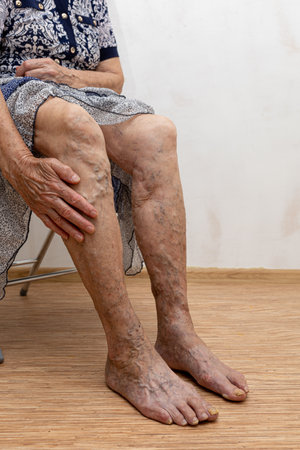 Elderly woman show bare legs with varicose veins inflammation. Need laser surgery. Thrombophlebitis, embolism issue.の写真素材