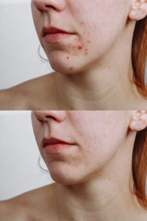 Young woman before and after acne treatment, closeup. Skin care conceptの写真素材