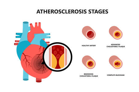 Human heart anatomy with atherosclerotic plaque. Cholesterol plaque in the blood vessels.のイラスト素材