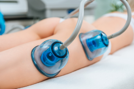 Selective focus of woman with cupping cups on legs and buttocksの写真素材