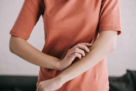 Cropped view of woman scratching hand while having allergyの写真素材