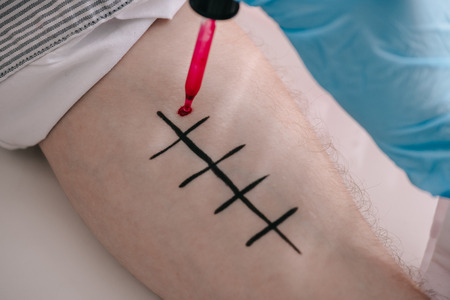 Cropped view of doctor in holding pipette with red liquid near male hand while making allergy testingの写真素材