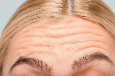 close up of forehead with wrinkles of woman 