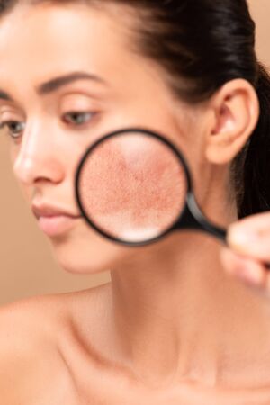selective focus of man holding magnifier near naked woman with problem skin isolated on beigeの写真素材