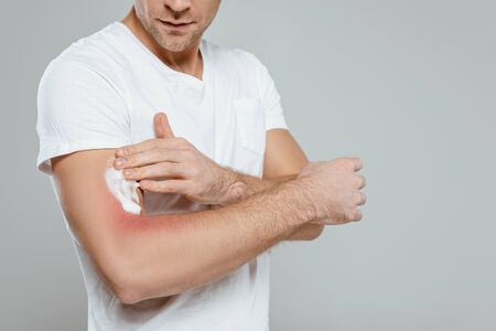 Cropped view of man applying foam on hand with redness isolated on grey
