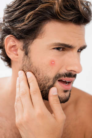 Confused man touching cheek with acne isolated on grayの写真素材