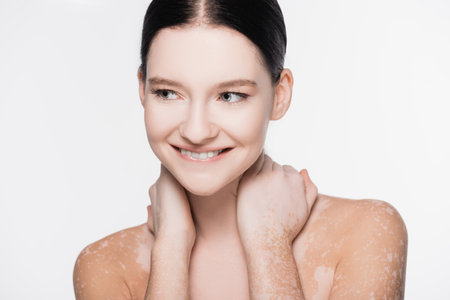 smiling young beautiful woman with vitiligo isolated on whiteの写真素材