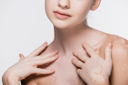 cropped view of young beautiful woman with vitiligo isolated on whiteの写真素材