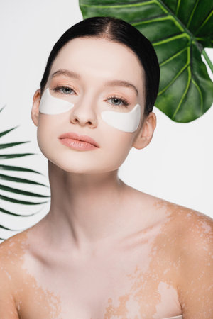 young beautiful woman with vitiligo and eye patches on face isolated on whiteの写真素材