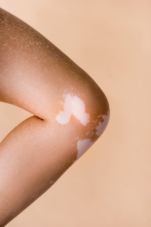 cropped view of female leg with vitiligo isolated on beige