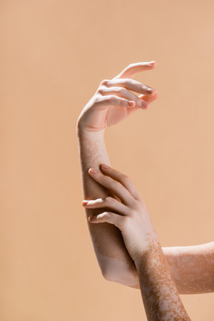 cropped view of female hands with vitiligo isolated on beigeの写真素材