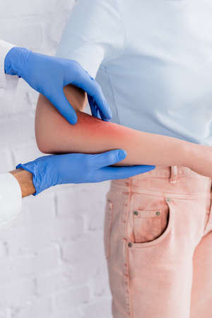 Cropped view of doctor in latex gloves touching hand of woman with allergy