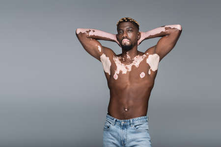 shirtless african american man with vitiligo skin and muscular torso posing with hands behind head isolated on greyの写真素材