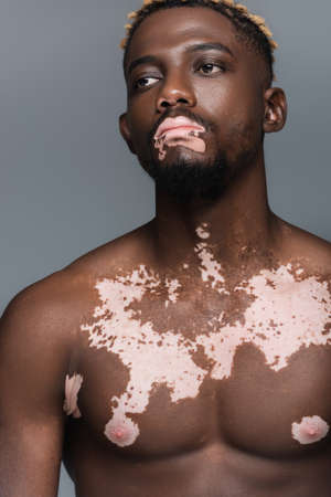 young and shirtless african american man with vitiligo skin looking away isolated on greyの写真素材