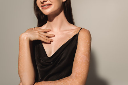 Cropped view of smiling woman with vitiligo touching chest on grey backgroundの写真素材