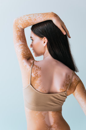 young woman with vitiligo touching brunette hair while looking away isolated on grey