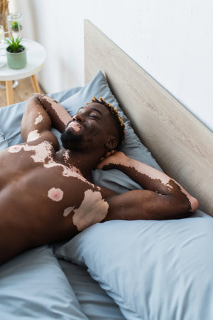Smiling african american man with vitiligo relaxing on bed at homeの写真素材