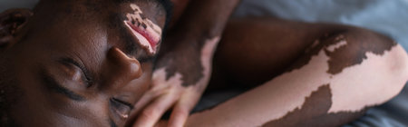 Top view of young african american man with vitiligo sleeping on bed at home, bannerの写真素材