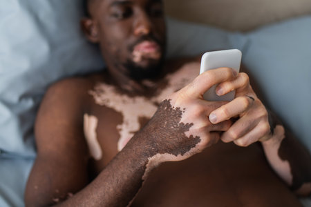 Blurred african american man with vitiligo using smartphone on bedの写真素材