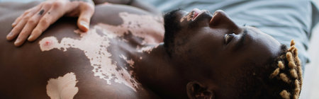 Shirtless african american man with vitiligo resting on bed at home, bannerの写真素材