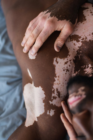 Cropped view of shirtless african american man with vitiligo touching skin on bedの写真素材