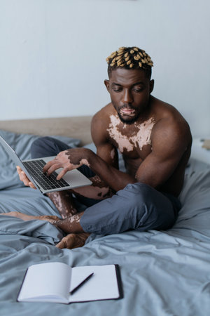 Shirtless african american man with vitiligo using laptop and looking at notebook on bedの写真素材