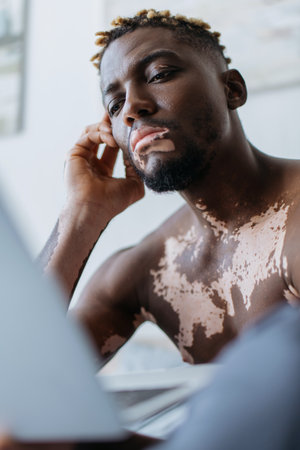 Focused african american man with vitiligo using blurred laptop at homeの写真素材