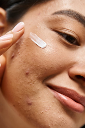 close up shot of young asian woman with skin issues applying acne treatment cream on face, verticalの写真素材