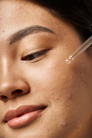 young woman with brunette hair applying serum to her face to treat skin acne, close up shotの写真素材