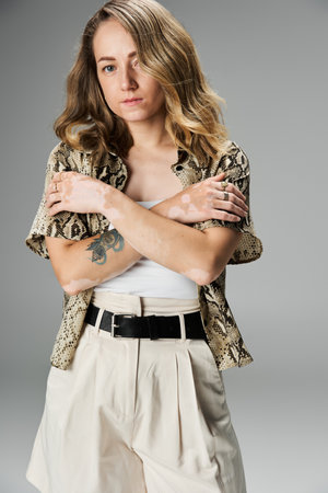 A young woman with vitiligo showcases her unique beauty while posing fashionably with confidence.の写真素材