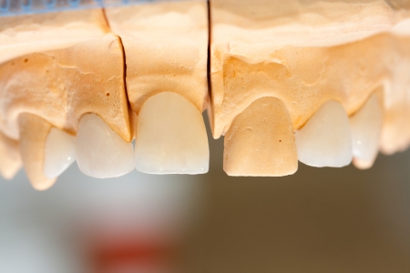 World leading e-max ceramic crowns and onlays on gypsum casting.の写真素材