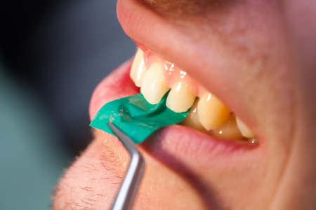 Dentist using articulating paper.の写真素材