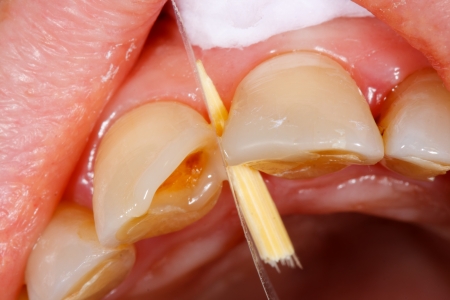 A broken tooth 's treatment with composite filling material - first steps.
の写真素材