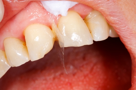 A broken tooth 's treatment with composite filling material - first steps.
の写真素材