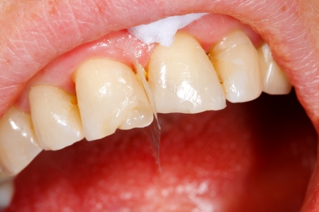A broken tooth 's treatment with composite filling material - almost finished.の写真素材