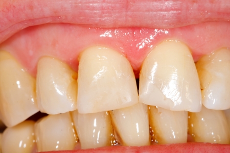 The final result of the treatment of a broken tooth.の写真素材