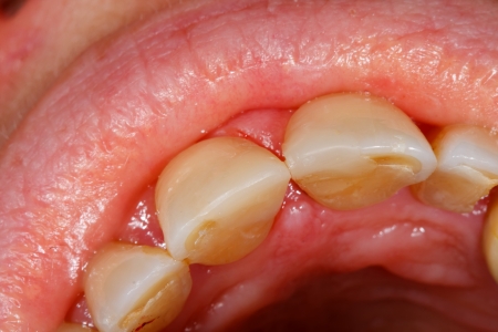 The final result of the treatment of a broken tooth.の写真素材