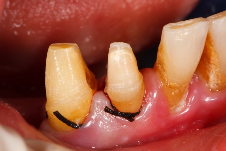 Buffed teeth under treatment with retraction dental thread placed in the gingival sulcus before imprinting.の写真素材