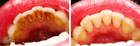 Two photos made by dentist, one before and one after the treatment of dental tartar - the subsidence is the result of residual food, smoking and coffe drinking - part of Beforeafter series.の写真素材