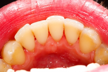 Inferior incisor teeth photographed by the dentist.の写真素材