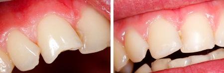 The treatment of a fractured tooth (incisor) - part of Beforeafter series.の写真素材