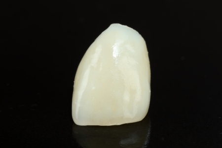 Highly aesthetic emax pressed ceramic crown.