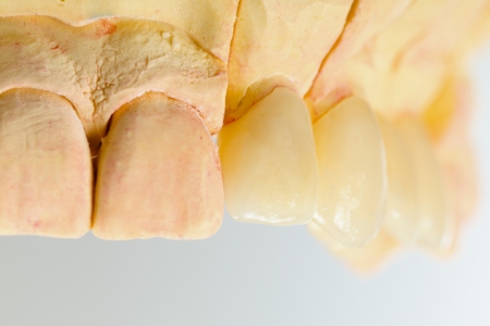 Anterior view of a highly aesthetic dental bridge and crown on gypsum model.の写真素材