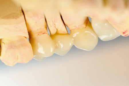 The inner view of a highly aesthetic dental bridge and crown on gypsum model.の写真素材