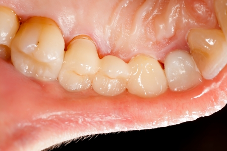 Highly aesthetic emax pressed ceramic bidge / crown in mouth.の写真素材